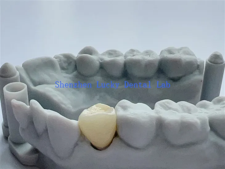 3D -Druck China Ästhetic Dental Vollkontur Zirkoniakrone