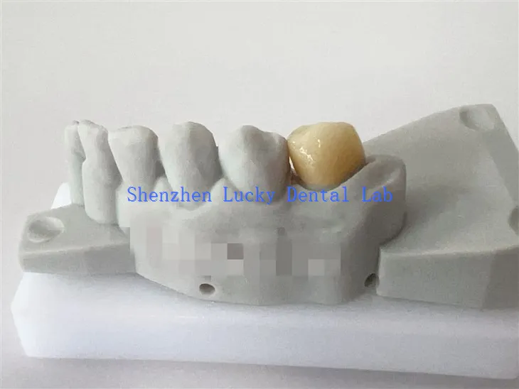 3D -Druck China Customized Dental Zirkonia Crown Factory