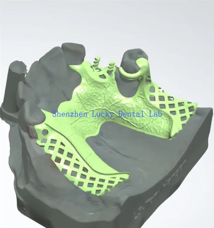 3D -Print -Zahnarzt -Metall -Rahmenhersteller