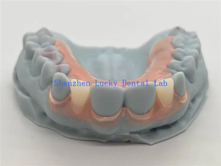 3D-Druck Dental TCS Flexible Teilprothesen