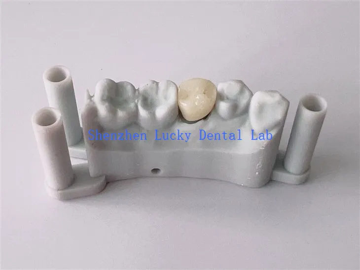 3D -Print -Zahnzirkonia -Kronhersteller