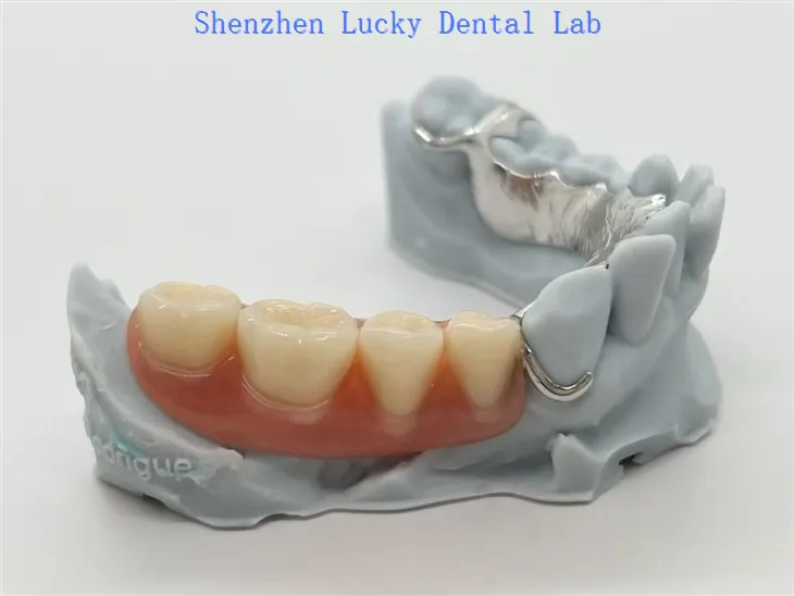3D-Druck-Metall-Co-Cr-Gerüst mit Acrylprothesen