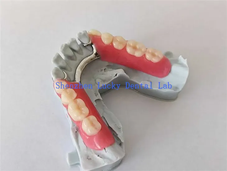 3D -Druck partieller Acryl -Prothese mit Metallgerüst versuchen im Zahnlabor
