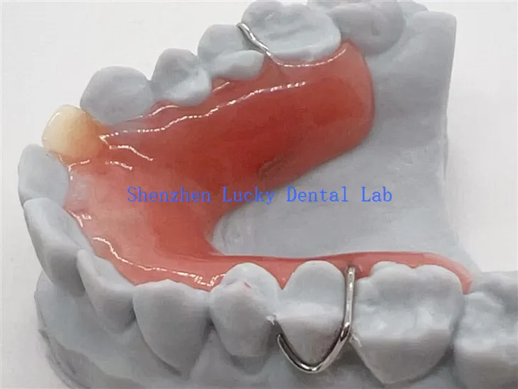 Herausnehmbare Teilprothese mit 3D-Druck und Acrylbasis