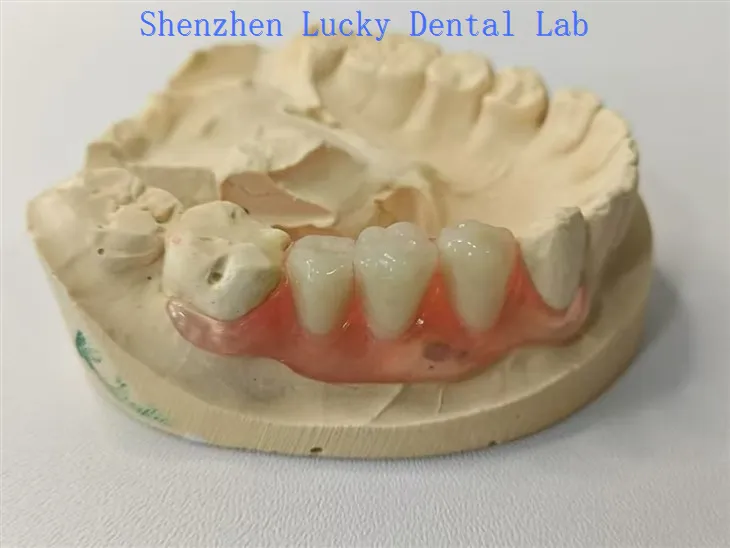 Ästhetischer Zahnleitungsflipper