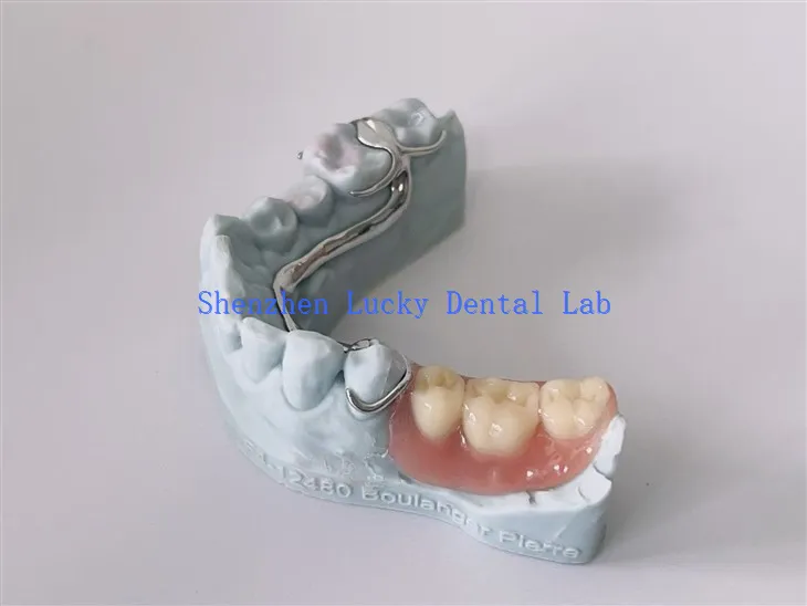 Erschwinglicher 3D -Print -Dental -Cocr -Metallrahmen mit Acrylprothesen