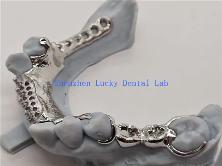 Zahndesign mit Legierungsrücken und Metallrahmen