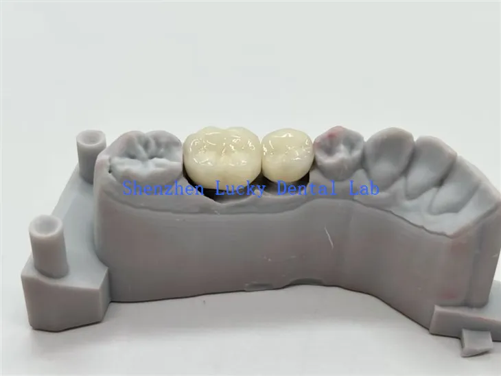 PFM-Zahnkronen aus CoCr-Legierung