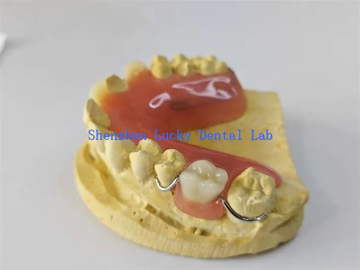 Komfortable Drahtbiegung Verschluss Acryl -Zahnprothese Dentallabor