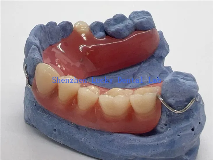 Bequeme partielle Acrylprothese mit Drahtverschluss