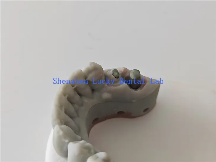 Kundenspezifischer 3D-Druck Zahnpostenkern Zahnlabor