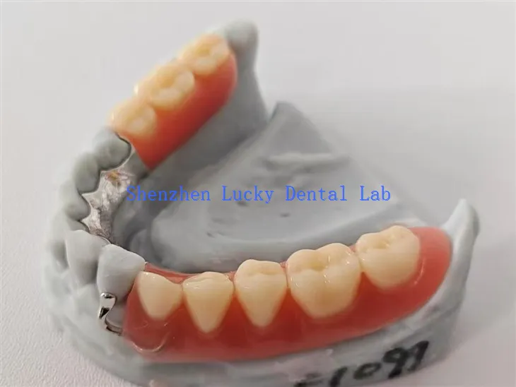 Customisierte Acryl -Zahnprothese mit lingual - Plattenmetall -Rahmen Zahnlabor