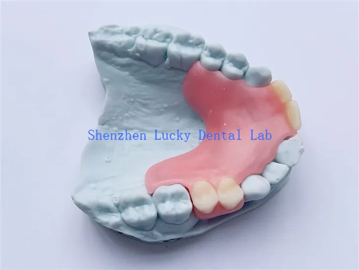 Angepfte zahnärztliche partielle flexible Zahnprothese bei Herstellern