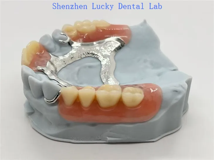 Dentales hufeisenförmiges Metallgerüst