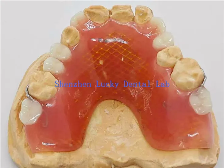 Zahnärztliche partielle Acrylhenture mit Metallnetz -Zahnarztlabor