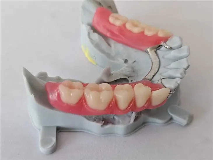Zahnärztliche partielle Zahnprothesen mit Metallrahmen/Basis versuchen