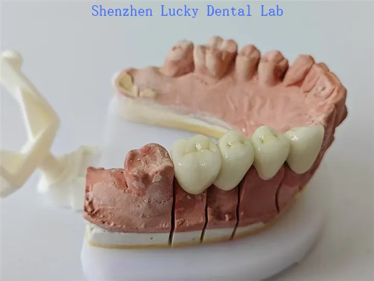 Zahnärztliche PFM -Cocr -Brücken kein Metallrand -Zahn -Dentallabor