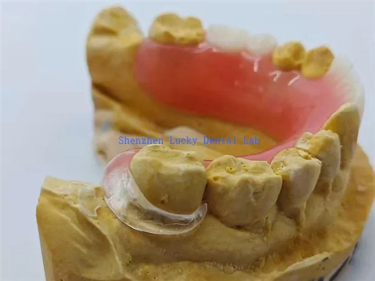 Acrylprothese mit klarem Verschluss