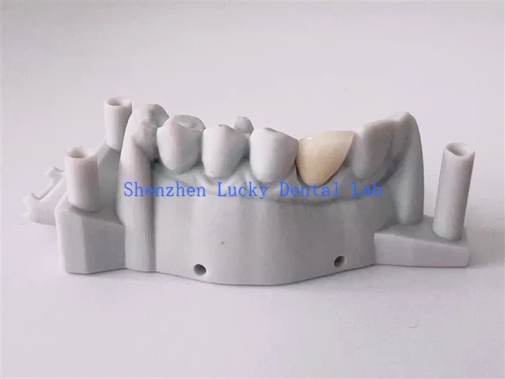 Ausgezeichnete 3D -Print -Dental -PFM -Cocr -Krone