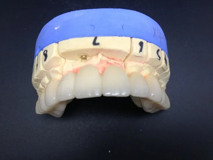 Hochpräzise zahnmedizinische Vollkeramik-Zirkonoxidkrone