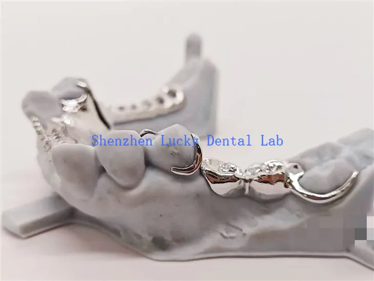 Metall -Framework mit legiertem Zahndesign