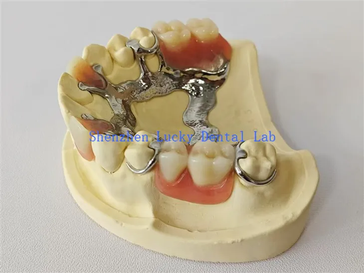 Palatal -Balken -Metallrahmen mit Acrylprothesen