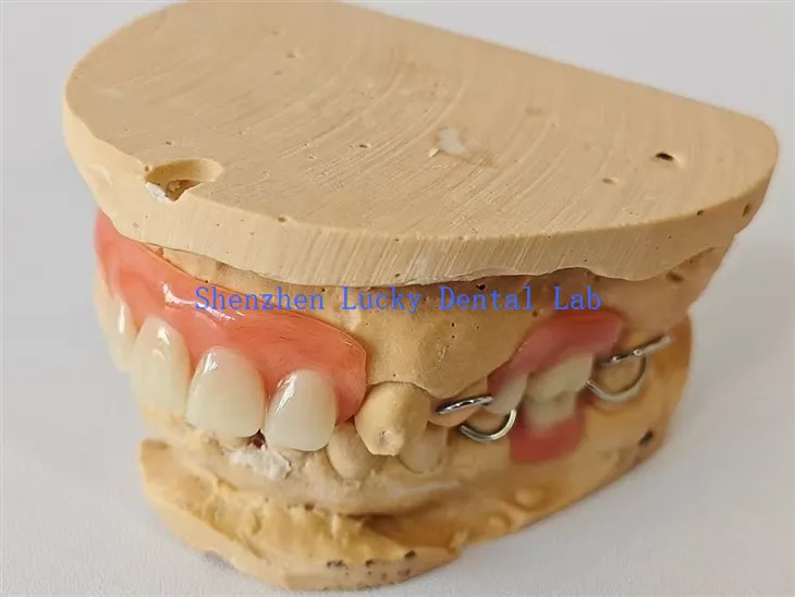 Partielle Acrylprothese mit Metallverschluss