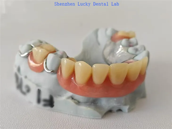 Teilprothese aus Acryl mit Drahtklammer-Metallgerüst
