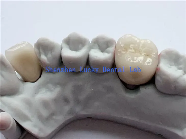 PFM Cocr Dental Crown No Metall Margin Dental Lab