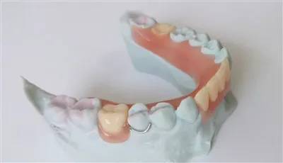 3D -Print -zahnärztliche partielle Acrylhenture mit Drahtverschluss