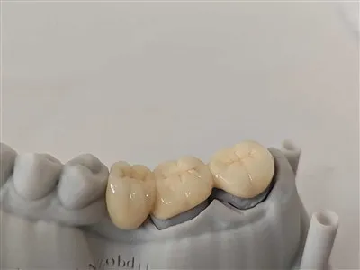 3D -Druck PFM Cocr Dental Bridge mit Post Core Dental Lab