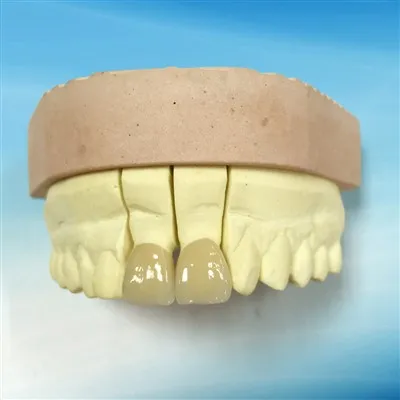 Ästhetische Dental-Vollkeramik-IPS-Emax-Krone