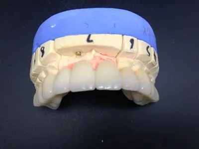 Hochpräzise zahnmedizinische Vollkeramik-Zirkonoxidkrone