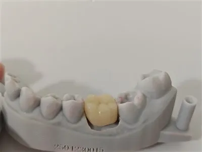 Hochwertiges Zahnarzt alle Porzellan IPS EMAX CROWN