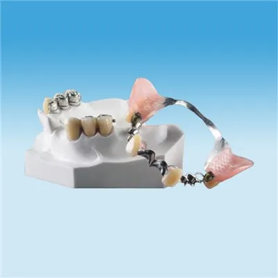 Natürliche Teilprothesenbefestigungen