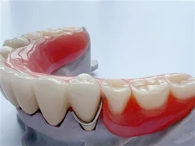 PFM -Cocr -Brücke mit teilweise Acrylprothese