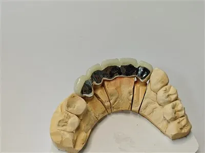 PFM Cocr Dental Crown mit lingualem Metall -Zahnlabor