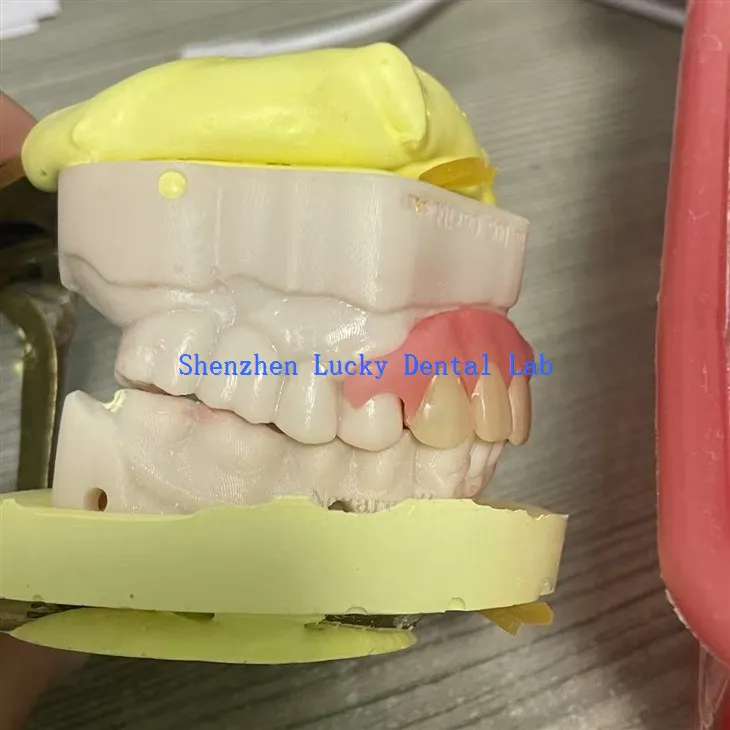 Bequeme partielle flexible Zahnprothese versuchen Sie im Zahnlabor